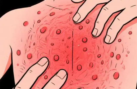 全身起疙瘩发痒怎么办?避免搔抓防止抓破后继发细菌感染