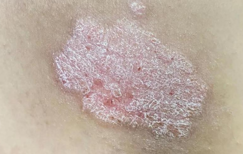 银屑病是一种慢性炎症性皮肤病，寻常型银屑病还能治吗？
